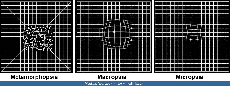 Info about Metamorphopsia 3 Metamorphopsia