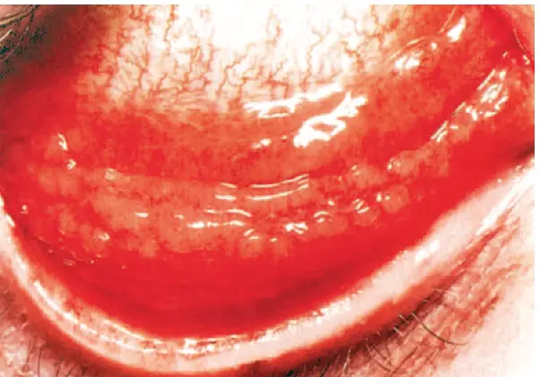 Types of pink eye, the 3 types of conjunctivitis and differential conjunctivitis symptoms 2 image 34