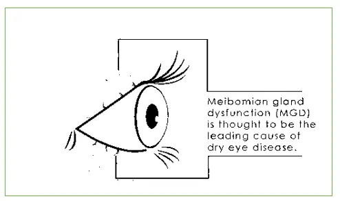 What is Dry Eye and what are its symptoms and treatments? 2 dry eye