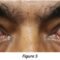 Eponymous-Signs-of-Thyroid-Ophthalmopathy