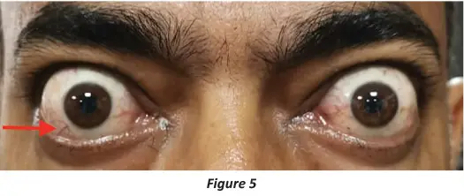 Eponymous-Signs-of-Thyroid-Ophthalmopathy