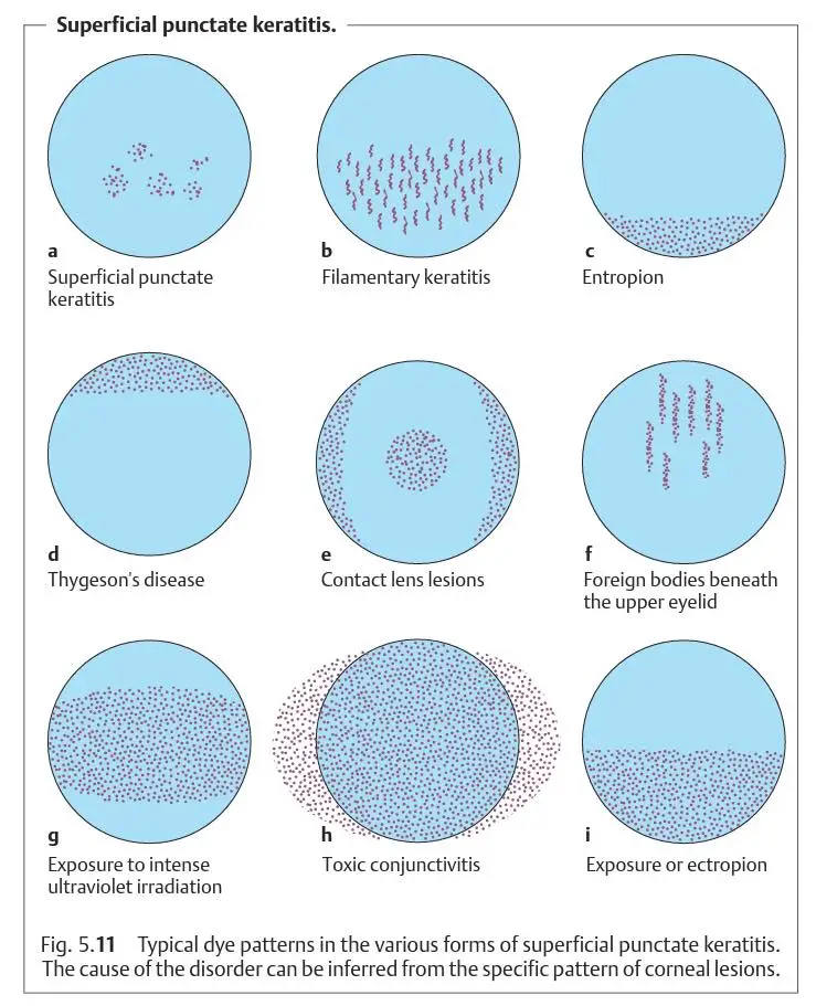 Superficial Punctate Keratitis