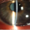 Superficial Punctate Keratitis (SPK): 11 Spk