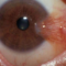pterygium