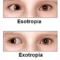 strabismus surgery