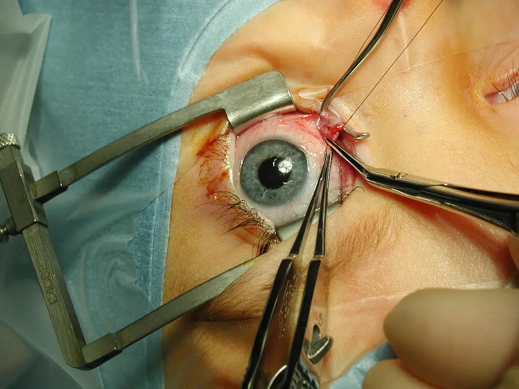Strabismus surgery 3 image 29