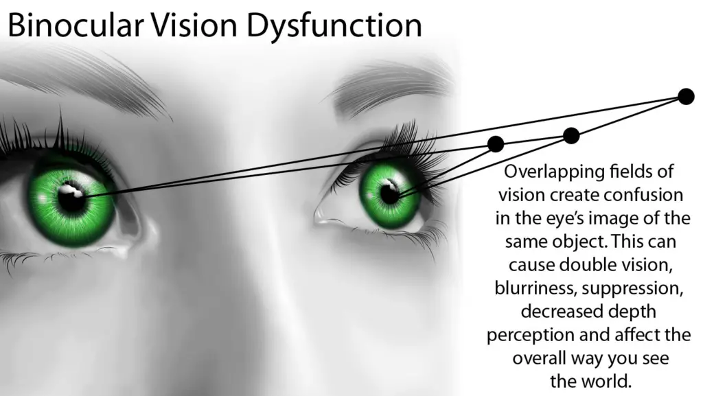 Binocular vision dysfunction/ BVD- Headache inspite of Correct glass prescription. 2 BVD- binocular vision dysfunction