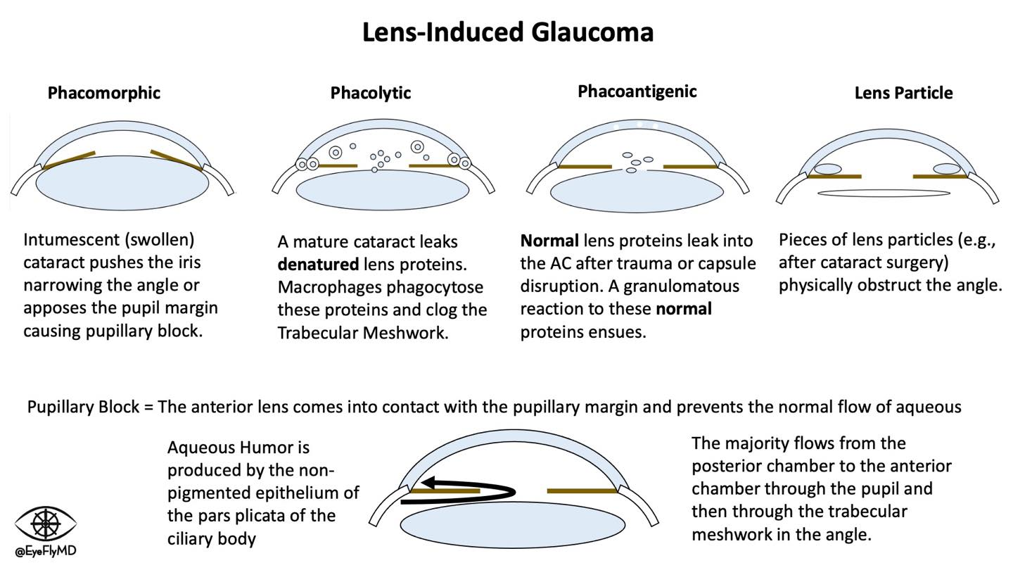 lens induced glaucoma