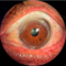 Diagnosis of Terrienโs Marginal Corneal Degeneration 13 Terrienโs Marginal Corneal Degeneration