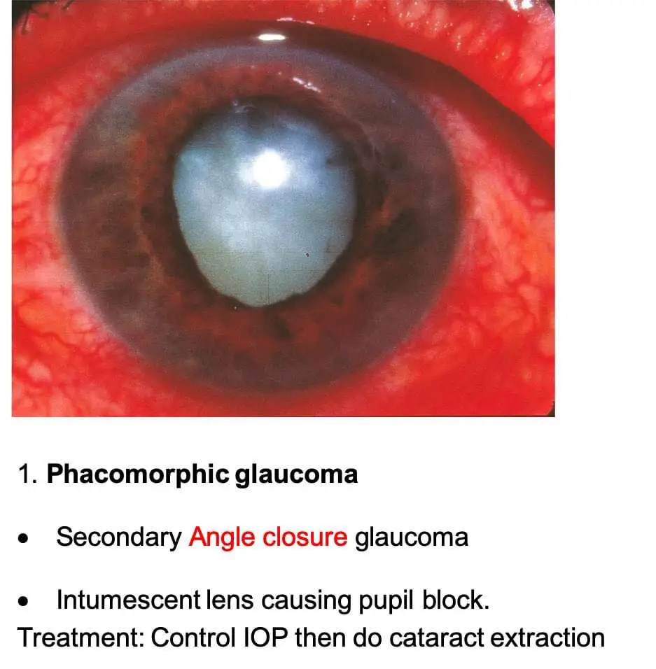 Lens induced glaucoma, Intumescent lens.