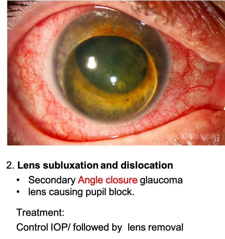 Lens induced glaucoma