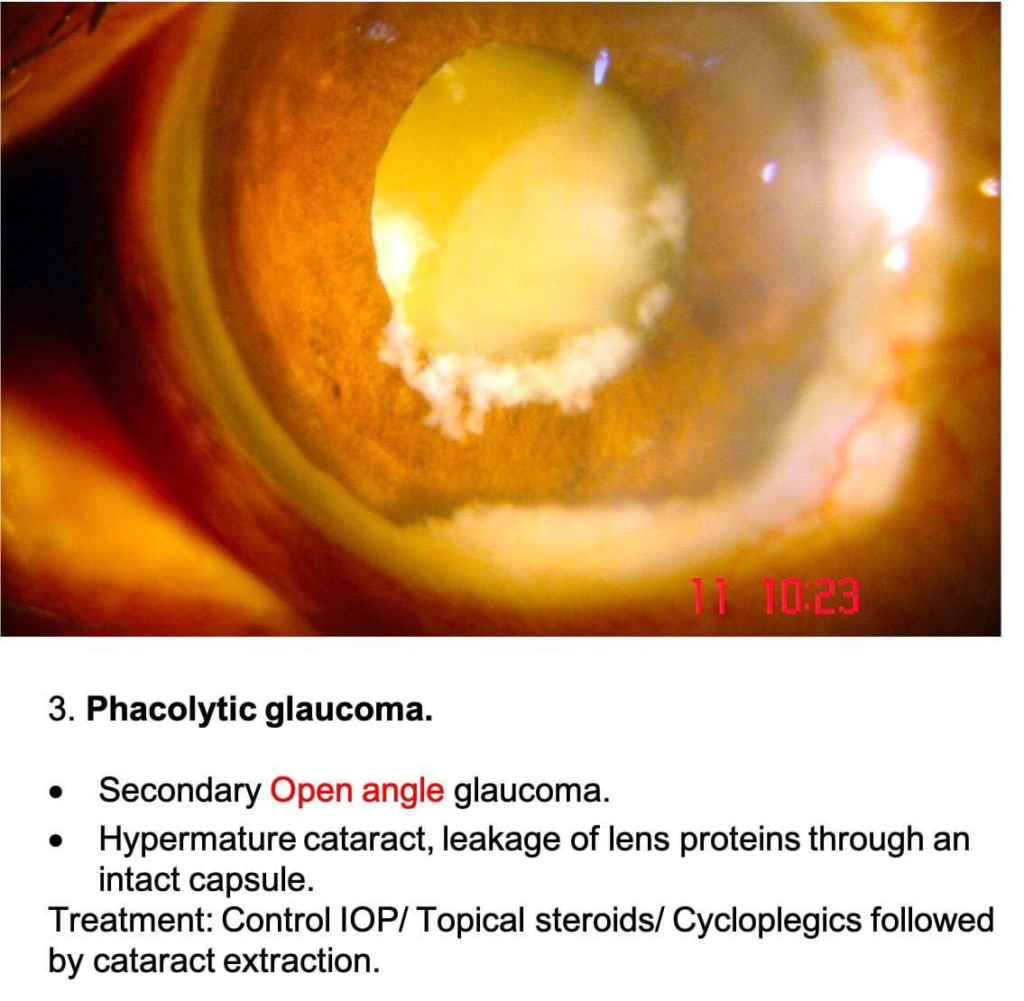 Lens induced glaucoma,Phacolytic Glaucoma: