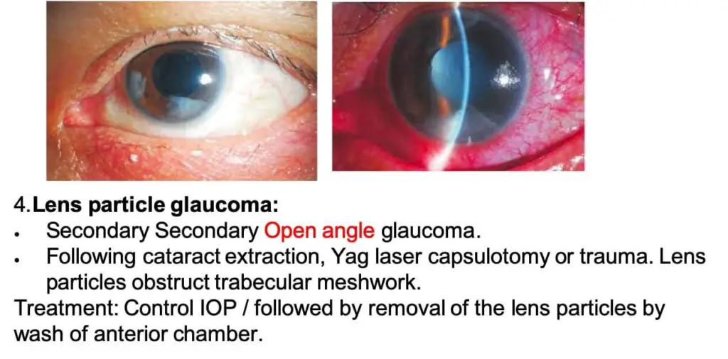 Lens induced glaucoma,Glaucoma Associated with Phacoanaphylaxis