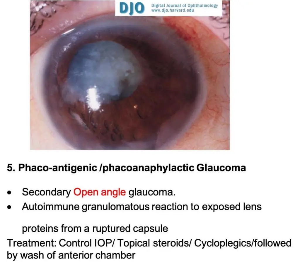 Lens induced glaucoma