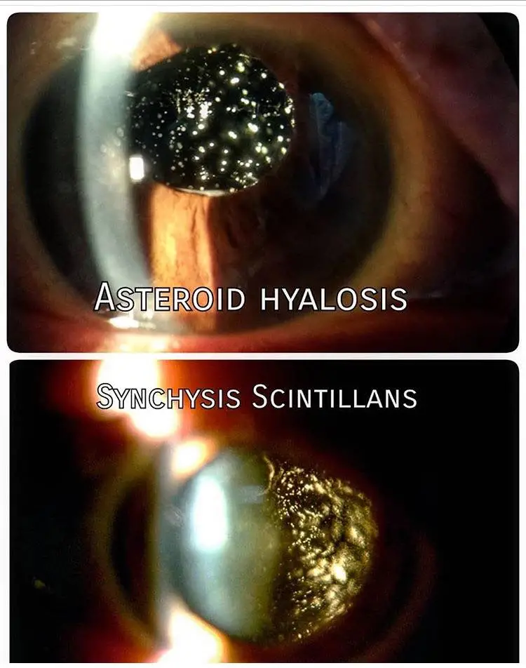 Asteroid hyalosis