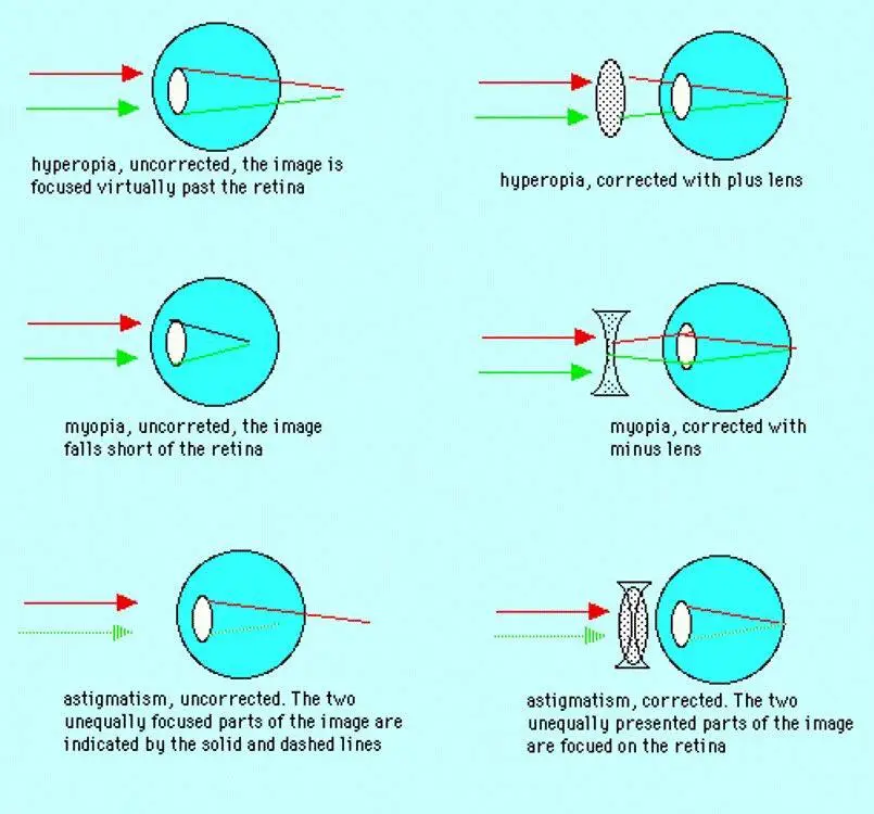 Emmetropia vs. ametropia