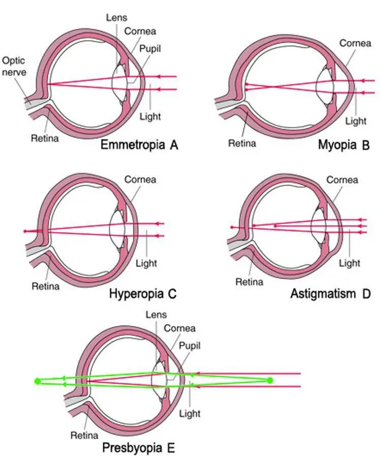 Emmetropia vs. ametropia