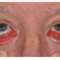 Conjunctival Lymphoma 10 Conjunctival lymphoma