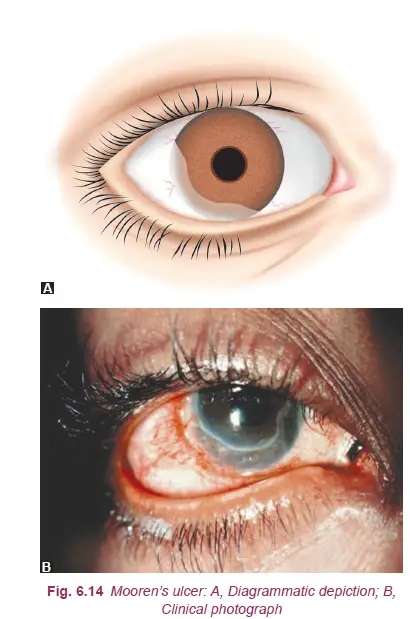 Mooren's ulcer