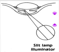 Slit Lamp Illumination Technique  and retroillumination in Clinical Applications