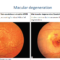types of macular degeration