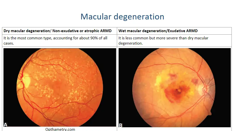 types of macular degeration