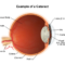 What is cataract? 13 cataract