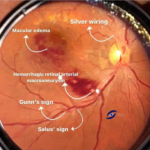 Gunn's sign and salus sign in Hypertensive retinopathy. 23 Gunn's sign and salus sign in Hypertensive retinopathy