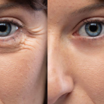 How safe is Botox under eyes to remove Eye bags and wrinkles? 10 Botox Under Eyes