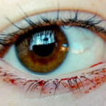 Haemolacria Bloody tears 10 Hemolacria