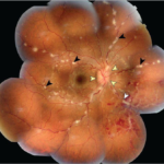 Candle Wax Dripping Lesions