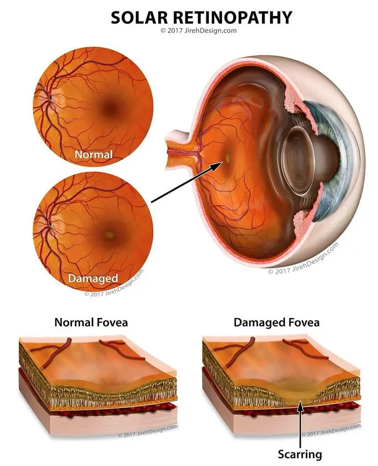 Solar Retinopathy-Symptoms, Diagnosis, Cause and Treatment 2 Solar Retinopathy