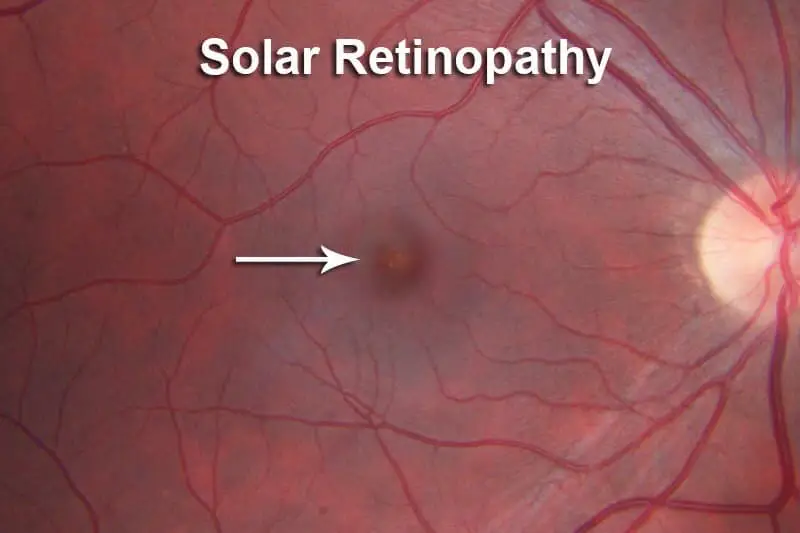 Solar Retinopathy-Symptoms, Diagnosis, Cause and Treatment 7 Solar Retinopathy