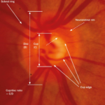 Optic disc and neuro retinal rim photographs 18 Optic disc and neuro retinal rim photographs