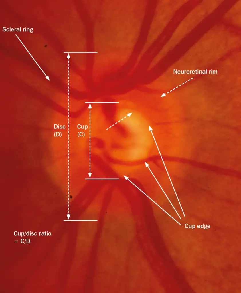 Optic disc and neuro retinal rim photographs