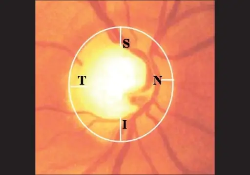 Optic disc and neuro retinal rim photographs