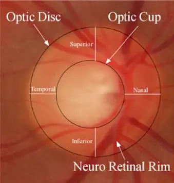 Optic disc and neuro retinal rim photographs