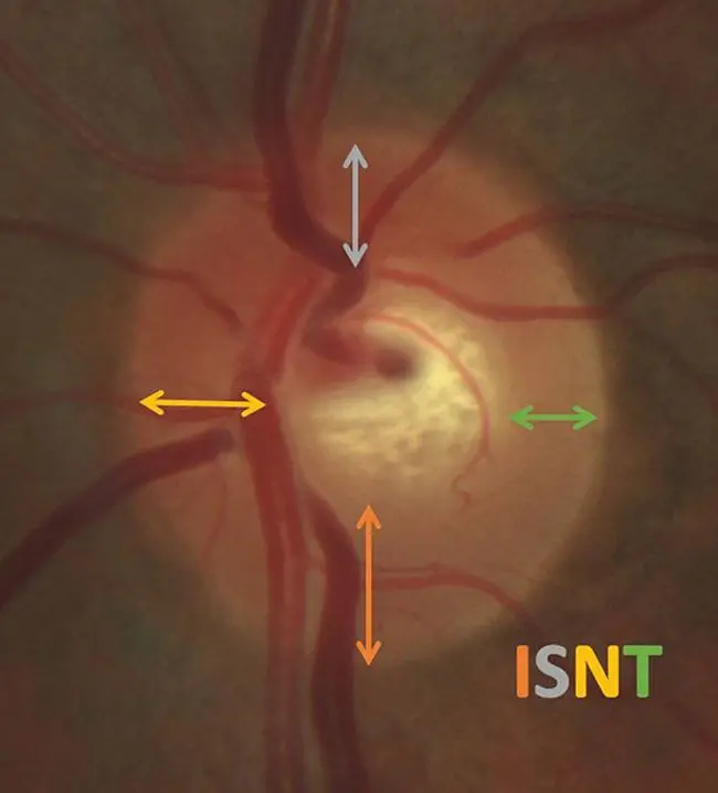 Optic disc and neuro retinal rim photographs