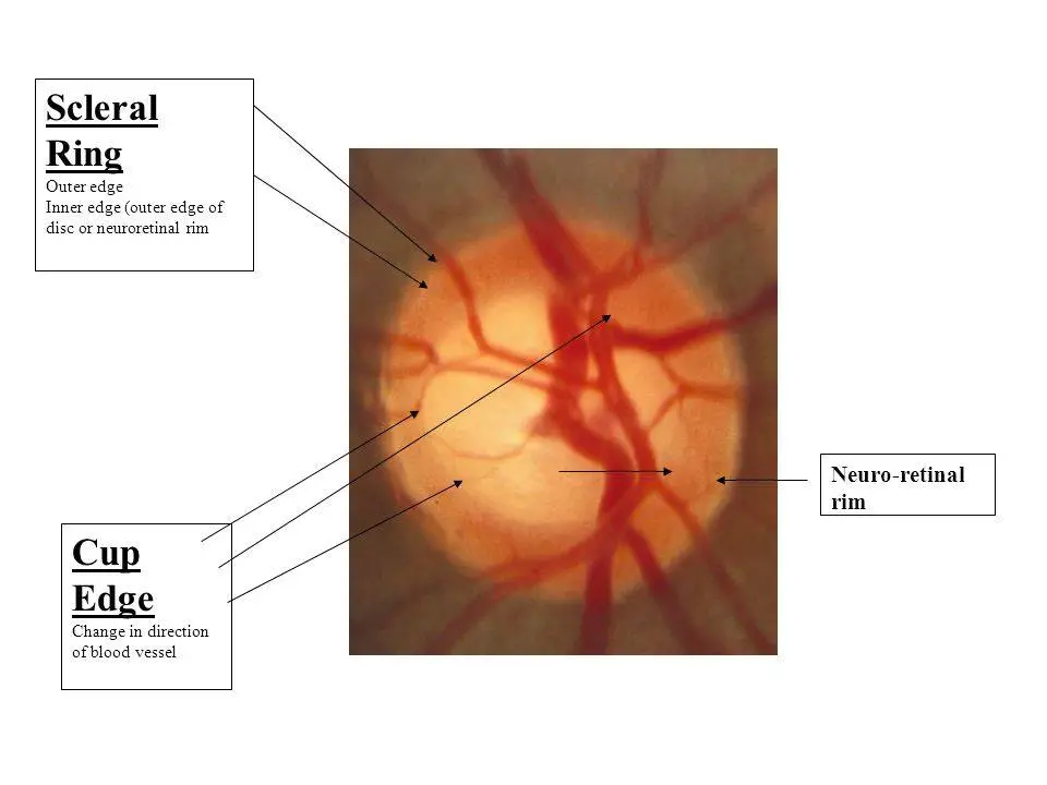 Optic disc and neuro retinal rim photographs