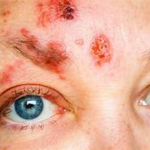 Antiviral eye drops for shingles 9 Antiviral eye drops for shingles