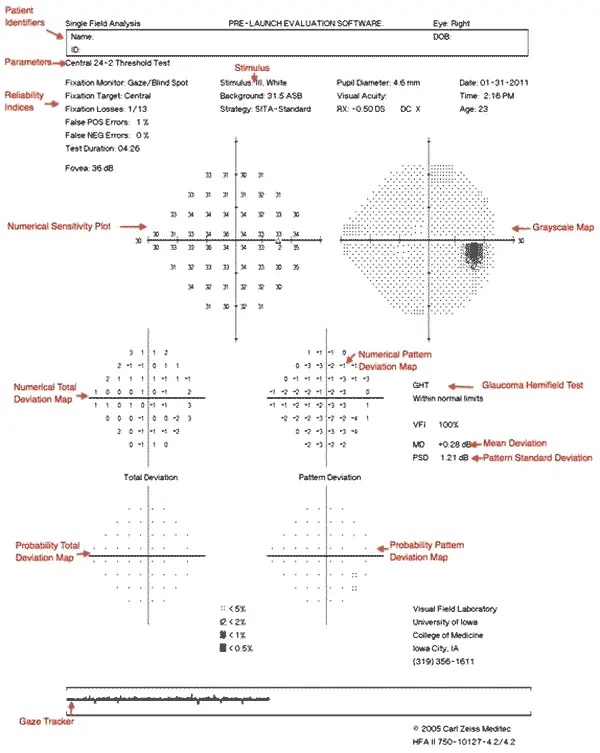 Humphrey visual field test 
