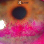 Rose Bengal Staining 14 Rose Bengal Staining