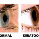 keratoconus artificial tears, Management of Keratoconus 15 keratoconus artificial tears