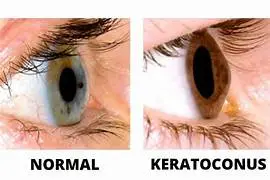keratoconus artificial tears