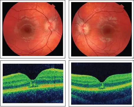 Solar Retinopathy-Symptoms, Diagnosis, Cause and Treatment 4 Solar Retinopathy