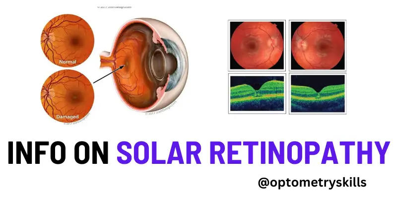 solar retinopathy
