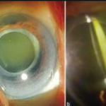 Lacteocrumenasia (liquified after cataract)