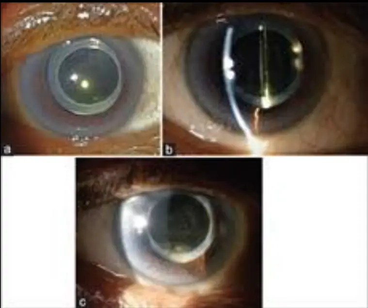 Lacteocrumenasia (liquified after cataract) 12 Lacteocrumenasia (liquified after cataract)