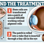 "Electrospinning "Retina cell breakthrough could help treat blindness 11 Electrospinning "Retina cell breakthrough could help treat blindness