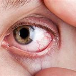Dry eye syndrome